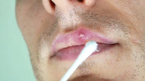 Herpes labialis on the lip of a Caucasian man. Face close-up.
Сold sores illness disease. Simplex virus. Application of therapeutic ointment.