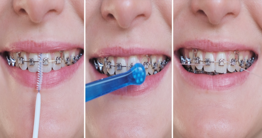 Collage cleaning braces teeth system, close-up. Oral care concept with braces. Woman brushing metal brackets by orthodontic toothbrushes, dental floss, monobuched brush. Healthcare hygiene | Shutterstock HD Video #1082583277