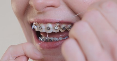 Woman using dental floss, close-up. Smiling female cropped face with metal braces on teeth. Caucasian girl shows how to flossing clean dental brackets, interdental spaces. Orthodontic hygiene. 4k