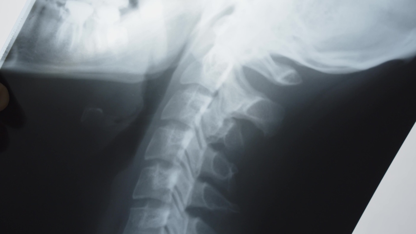 hand shows an x-ray of the skull on a white light background, a Healthcare Video by Semyon Prudiy