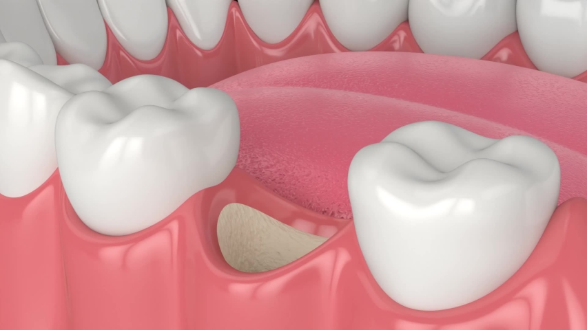 3d dental bone grafting and bone augmentation procedure Royalty-Free Stock Footage #1083120955