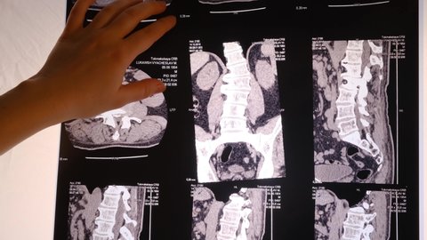 The doctor shows a CT image of the spine of a patient with scoliosis and intervertebral hernia. November 24, 2021, Zaporozhye, Ukraine