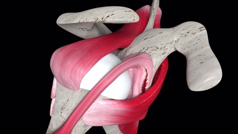 This 3d medical animation shows a shouder labral tear with surgical repair