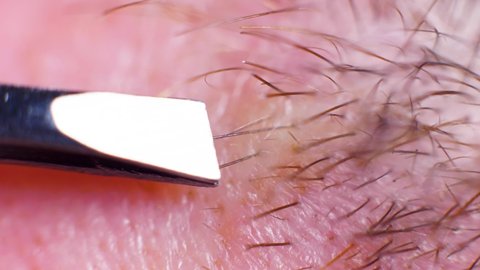 4K Super macro shot of hair ral with tweezers, on a caucasian person, at an extreme close up, in a studio.