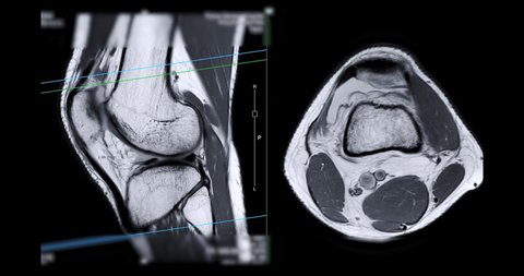 MRI knee or Magnetic resonance imaging of knee joint  Axial PDW view for detect acl ligament tear.