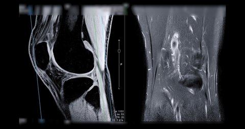 MRI knee or Magnetic resonance imaging of knee joint  sagittal 3D watt and coronal T2 FS view for detect acl ligament tear.