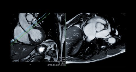 MRI heart or Cardiac MRI ( magnetic resonance imaging ) of heart in Short axis view showing heart beating for detecting heart disease with aortic valve.