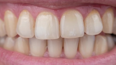 Teeth Before After Stock Video Footage 4k And Hd Video Clips Shutterstock