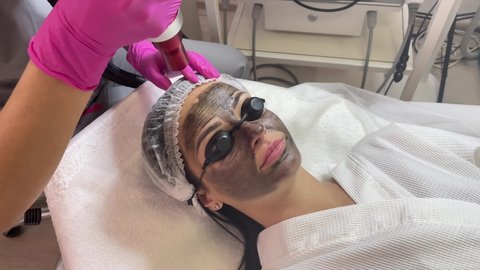 Carbon face peeling procedure. Laser pulses clean skin of the face. Hardware cosmetology treatment. Process of photothermolysis, warming the skin, laser carbon peeling. Facial skin rejuvenation.