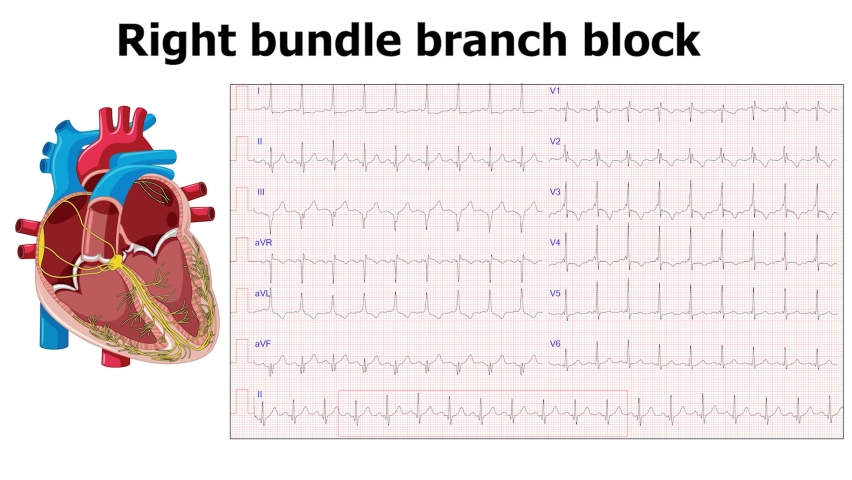 heart arrhythmia right bundle branch block (RBBB) with ecg Royalty-Free Stock Footage #1083661936