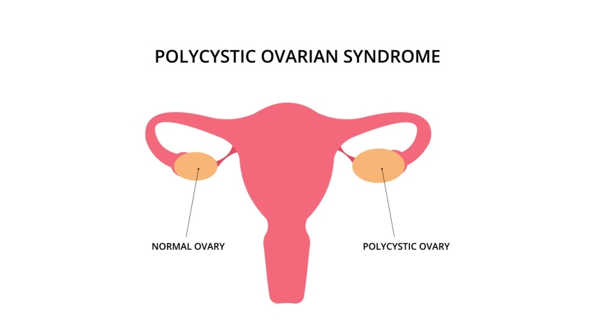 Polycystic ovarian syndrome 2D animation. Uterus, infertility, gynecology. For topics like pcos, disease, pelvic floor Royalty-Free Stock Footage #1083693328