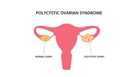 Polycystic ovarian syndrome 2D animation. Uterus, infertility, gynecology. For topics like pcos, disease, pelvic floor
