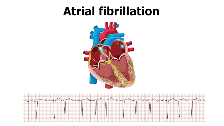 heart arrhythmia atrial fibrillation with ecg Royalty-Free Stock Footage #1083886453