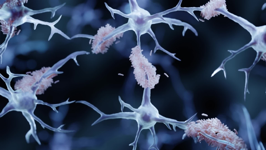 Alzheimer's disease, Amyloid plaques aggregates | Shutterstock HD Video #1083946963