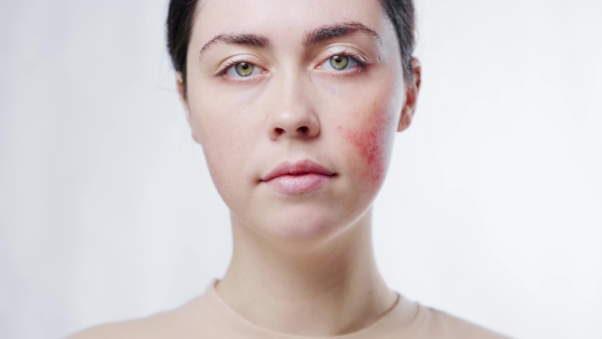 Close-up portrait of a young beautiful woman turning and showing rosacea on her cheek. White background. The concept of aesthetic skin problem	
 Royalty-Free Stock Footage #1083951985