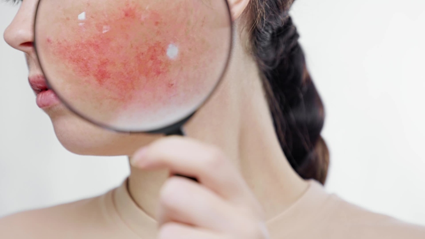 Young pretty woman shows redness on her cheek through a magnifying glass. Close up. The concept of rosacea and skin problems	
 | Shutterstock HD Video #1083951988