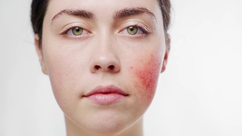 Close-up face of a young beautiful woman touching the inflammation rosacea on her cheek with her fingers. White background. The concept of couperose	
