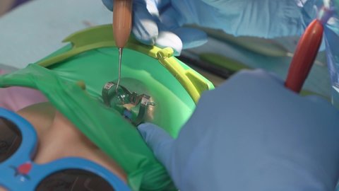 dentist uses Cofferdam for treatment caries and tooth reconstruction of child - this is material with which dentist isolates diseased tooth for duration of treatment. piece of latex with hole.
