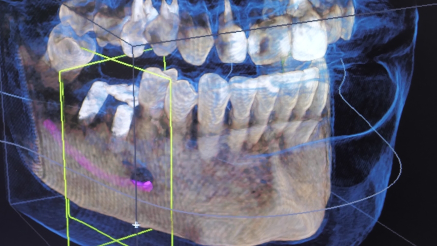 Close-up 3d model of X-ray images of the patient's jaw and teeth on the monitor, modern dentistry. MRI of the jaw in a modern dental clinic. Installation of a dental implant.The concept of dental care Royalty-Free Stock Footage #1084457368