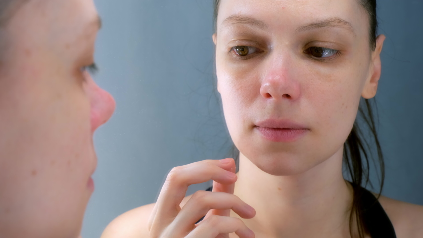 Stomatitis in woman's mouth after dental treatment, disease in the mouth. Stomatitis on the lower lip. Large ulcers in the mouth under the lower teeth. Woman is looking at mirror. Royalty-Free Stock Footage #1084759687