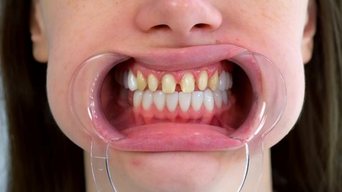 Mouth of woman with yellow bad teeth preparing to install ceramic veneers. Teeth sharpened by dentist before installing crowns and veneers. Dentistry treatment, prosthetics of teeth concept.