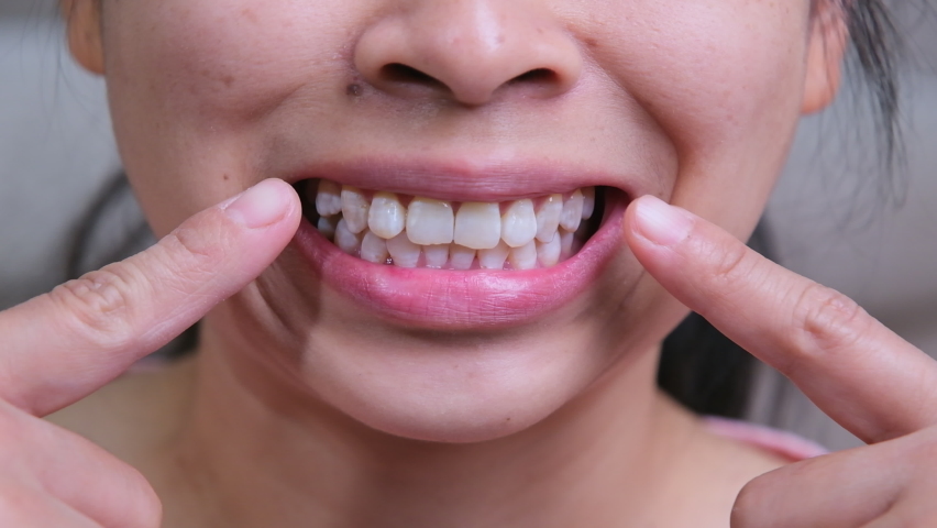 Asian woman smiles revealing white tooth spot, fluorosis in female teeth. Natural teeth of a middle age woman, jaw joint dysfunction. Health and dental care concepts. | Shutterstock HD Video #1085008480