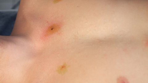Wounds on man's chest after laser removing of moles surgery, closeup view. One day surgery concept. Sore and wound after operation treated with iodine.