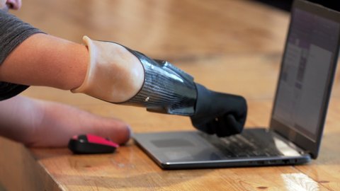 Close view of a modern bionic hand. A man living with a disability with amputated two stump hands is typing on the laptop with modern bionic prothesis