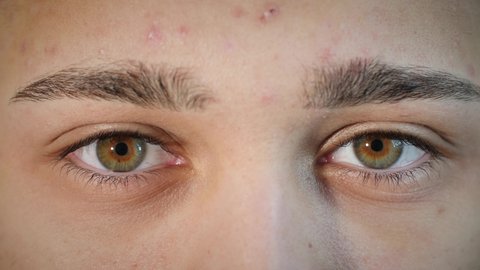 Macro close up of happy man's face smiling with beautiful hazel eye and pimples. Young Arab male model with different eye colors and acne skin condition laughing at camera. Slow-motion, 4K.