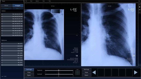 Medical Software Interface Showing Real Chest X-Ray of a Sick Patient. Authentic Image Allows Health Care Professionals, Doctors to Diagnose Disease, tumors, pneumonia, bone fracture, lung cancer
