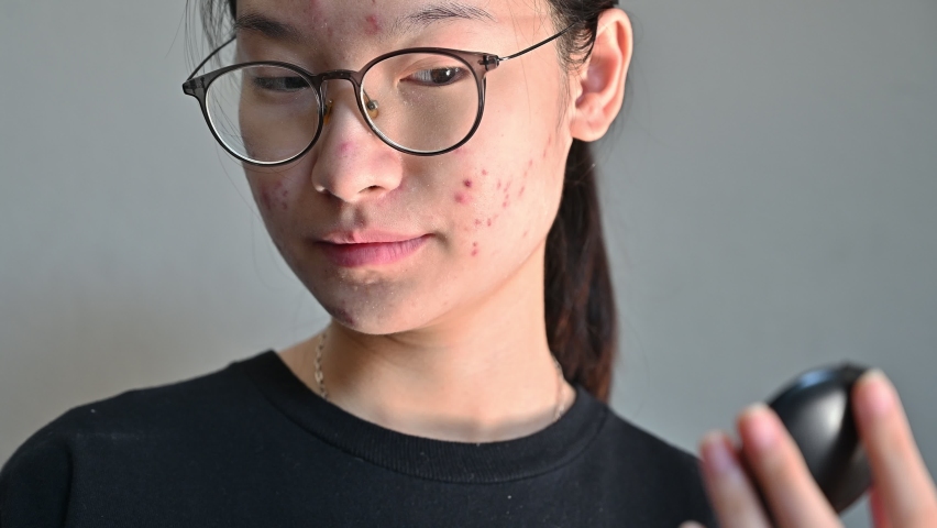 Young Asian woman worried caused of acne inflammation and acne scar occur on her face. Inflamed acne consists of swelling, redness, and pores that are deeply clogged with bacteria, oil, and dead skin. Royalty-Free Stock Footage #1085191940