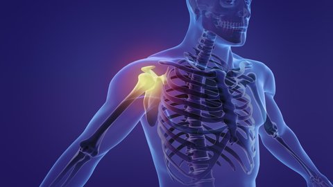 Animation of a painful shoulder
