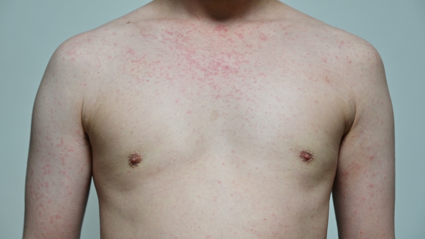 ERYTHEMA-INFECTIOSUM Footage, Videos and Clips in HD and 4K - Avopix.com