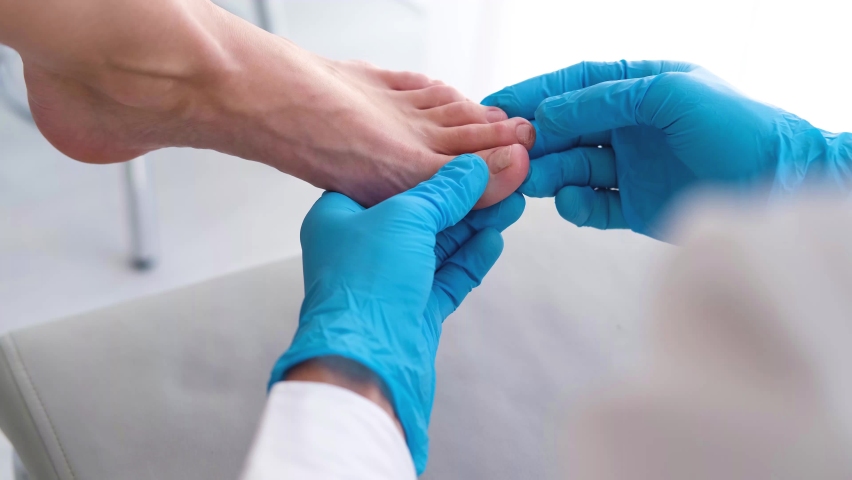 A close-up of a foot with a fungus on the nails is examined by a doctor in gloves. Onycholysis: detachment of the nail from the nail bed. Royalty-Free Stock Footage #1085373080