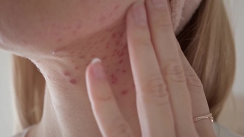 Woman with inflamed cystic acne on her neck and jawline area, close up.