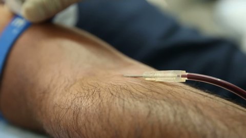 Take blood from volunteers at donor center. The nurse puts a tourniquet on arm, pricks needle into patients arm. Transfusion Machine Collects Blood Plasma 