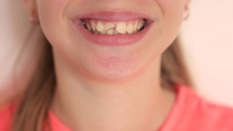 The girl shows broken front teeth. The child's visit to the dentist. Two front female teeth were broken