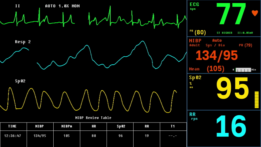 ECG System Ui Monitoring Health Condition Of Patient. Electrocardiogram System Monitoring And Recording Health Of Vital Organs. Monitoring System Testing Heart Health By Analyzing Electrical Signals Royalty-Free Stock Footage #1085718968