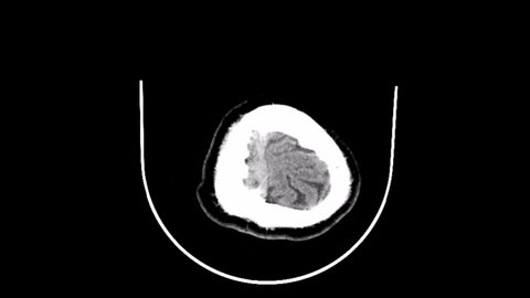 axial head ct scan image of right-sided epidural hemorrhage
