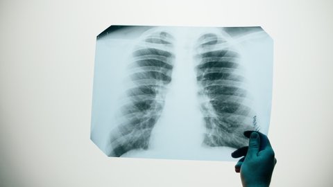 Lungs x-ray close-up. Doctor looking at ribs roentgen, human chest. Healthcare and medicine concept, checkup.