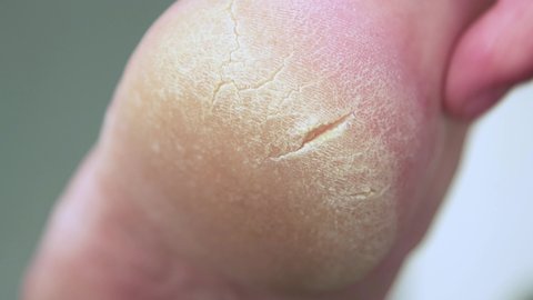 The index finger shows a cracked heel with rough skin on the foot. We do the pedicure ourselves. Self-care for your feet. Isolated video, close-up. Warm, soft light. UHD 4K.
