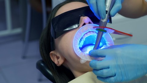Dentist is fixing woman's veneers and ceramic crowns on teeth using UV lamp in dentistry clinic. Dental treatment. Dentistry, prosthodontics, prosthetics concept. Orthodontist cure.