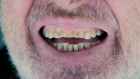 Mouth of a senior man with crooked yellow teeth close-up. Tooth in bad condition. High quality 4k footage in slow motion