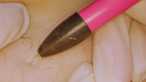Tracking Macro Extreme Close-Up Shot of electric electrolysis epilation, hair removal, with Laowa Lens and dolly slider zoom. 4k prores 422.