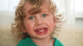 little boy with an allergy on his cheeks shows his tongue and teeth. Cursing at the camera Video 4k