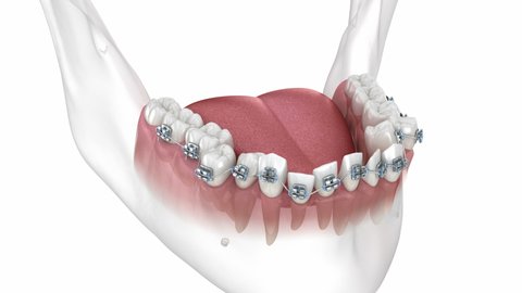 Abnormal teeth position and correction with metal braces tretament. Medically accurate dental 3D animation