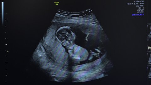 Ultrasonography of pregnant woman. Baby in mothers womb, 14 weeks of life. Human embryo on an ultrasound display.