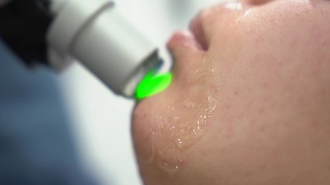 Close up of woman face modern alexandrite laser hair removal procedure. Concept of women beauty, cosmetology, epilation