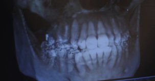 X-ray image of the patient's jaw on the doctor's monitor, close-up. Orthopantomography device for teeth, MRI, Video in 4k, red komodo