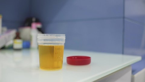 Male Hand Closes Urine Container.
Male hand close up shutting the lid of the urine container with analyzes. Container for urine analysis.